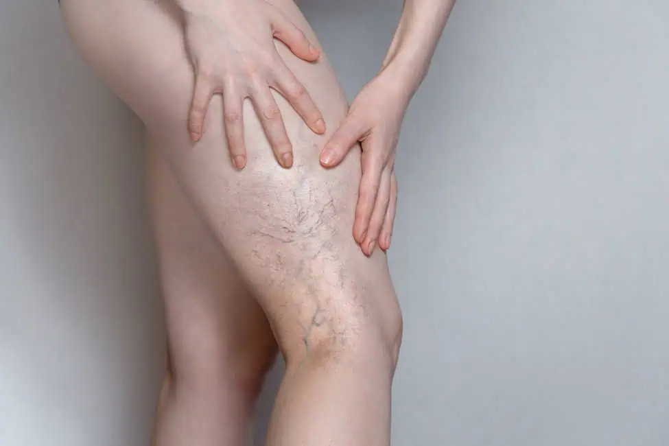 Vascular Treatments by Heartland Luxe Aesthetics in Kearney, NE