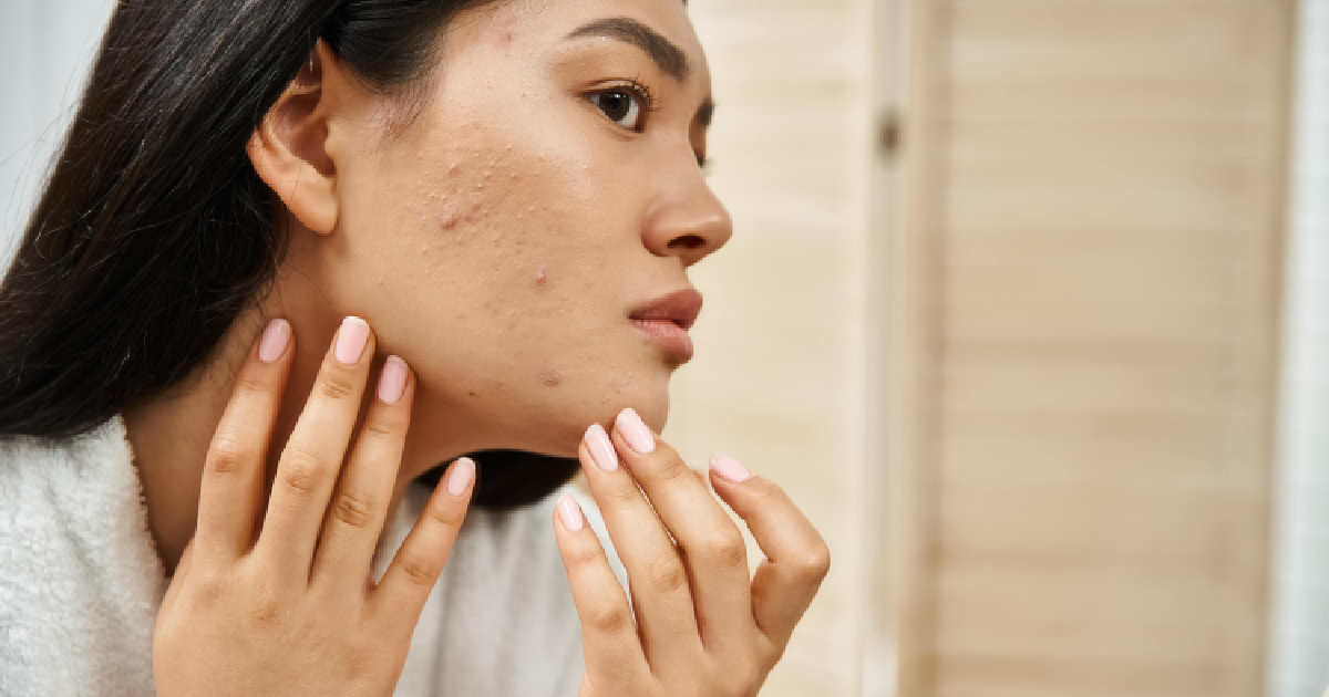 Young woman examining acne and acne scars on her cheek in a mirror, touching her face with both hands, after Acne Treatment in Kearney, NE.