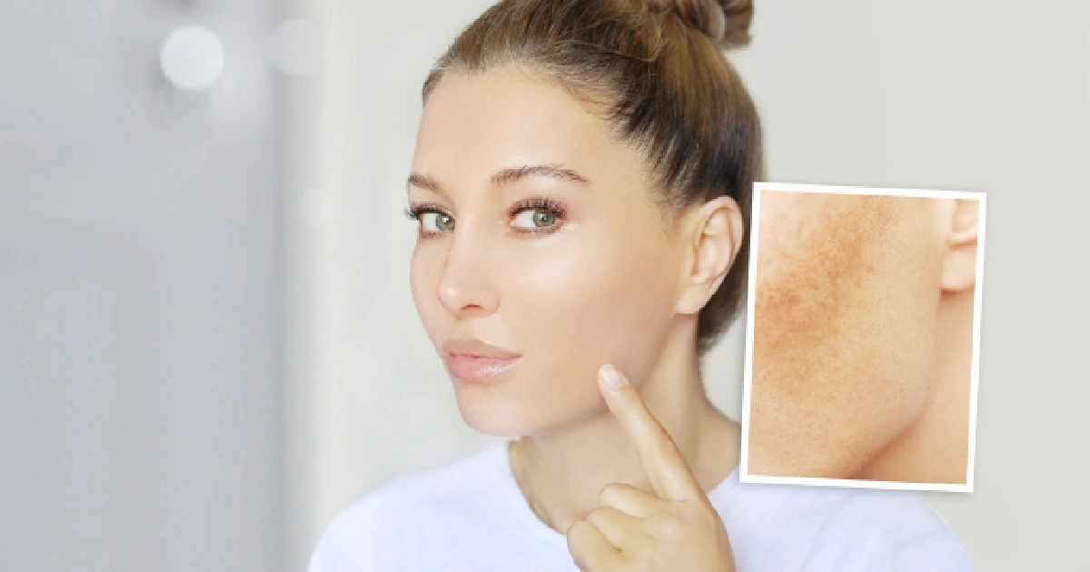 women having "Hyperpigmentation Treatment in Kearney, NE