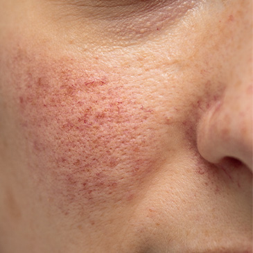 Luxe-Aesthetics-Overview-Images-Broken-Capillaries