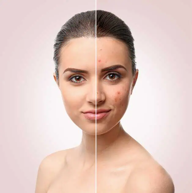Acne Treatment in Kearney, NE by Heartland Luxe Aesthetics